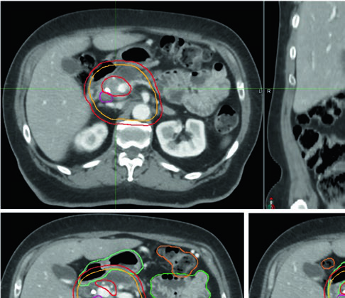 Cáncer de Páncreas: Delineación y Planificación RT