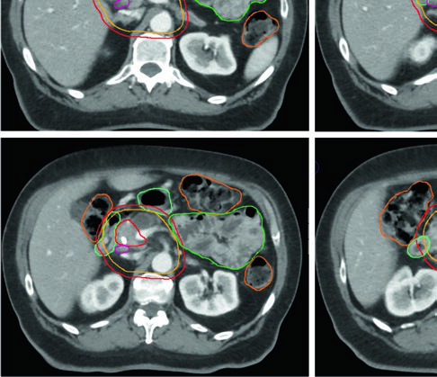 Cortes axiales de TC mostrando GTV, CTV y contornos de OARs en adenocarcinoma pancreático borderline resecable con extensión vascular a lo largo de arteria hepática común, tronco celíaco y AMS