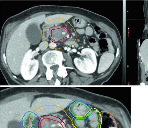 TC axial, sagital y coronal de tumor pancreático irresecable tratado con 75 Gy en 25 fracciones con CBCT diario y DIBH, mostrando GTV, PTV alta dosis, PTV dosis microscópica y PRVs de estómago e intestino delgado