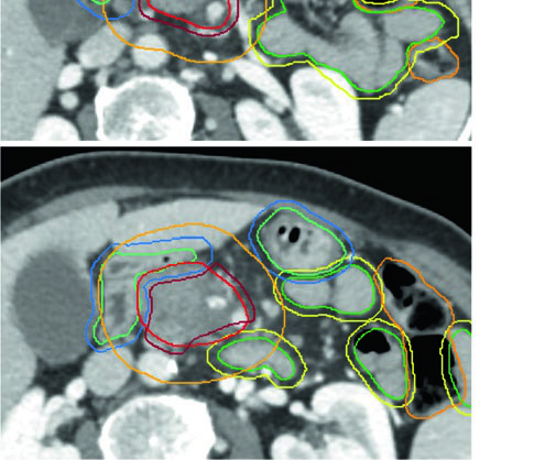 Cortes axiales de TC mostrando exclusión de OARs del PTV con margen de seguridad adicional en tratamiento ablativo de cáncer pancreático, con PRVs de estómago e intestino delgado