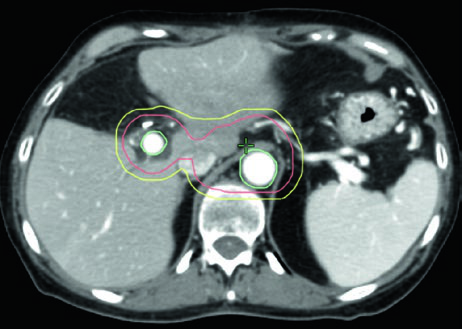 TC axial post-pancreatectomía mostrando ROIs del atlas RTOG 0848 con contornos de CTV y PTV para tratamiento adyuvante, incluyendo vena porta y aorta