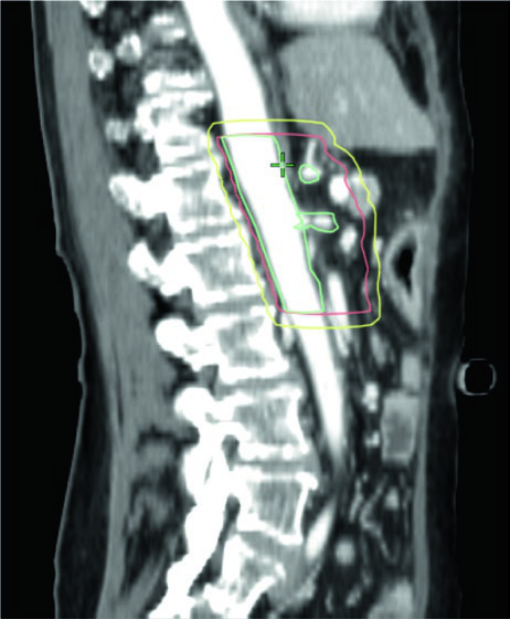 Reconstrucción parasagital de TC post-pancreatectomía mostrando extensión craneocaudal del PTV adyuvante con ROIs del atlas RTOG 0848