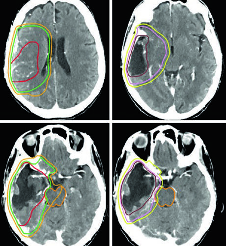 Tumores Malignos do SNC: Delineamento e Margens