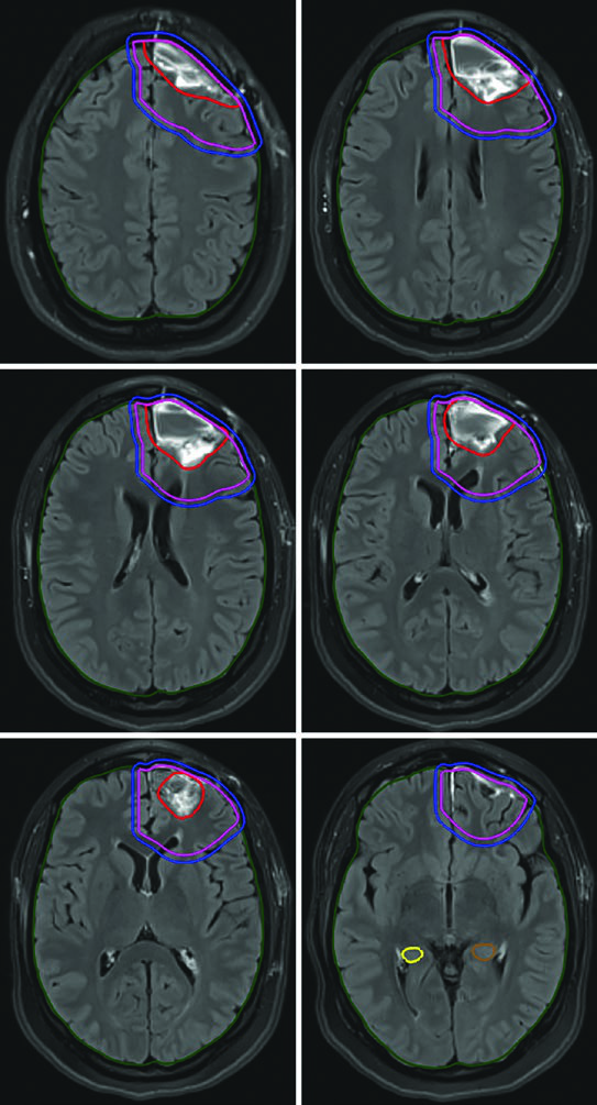 RM FLAIR de planejamento mostrando astrocitoma anaplásico frontal esquerdo não captante após ressecção total com GTV em vermelho, CTV em rosa e PTV em azul