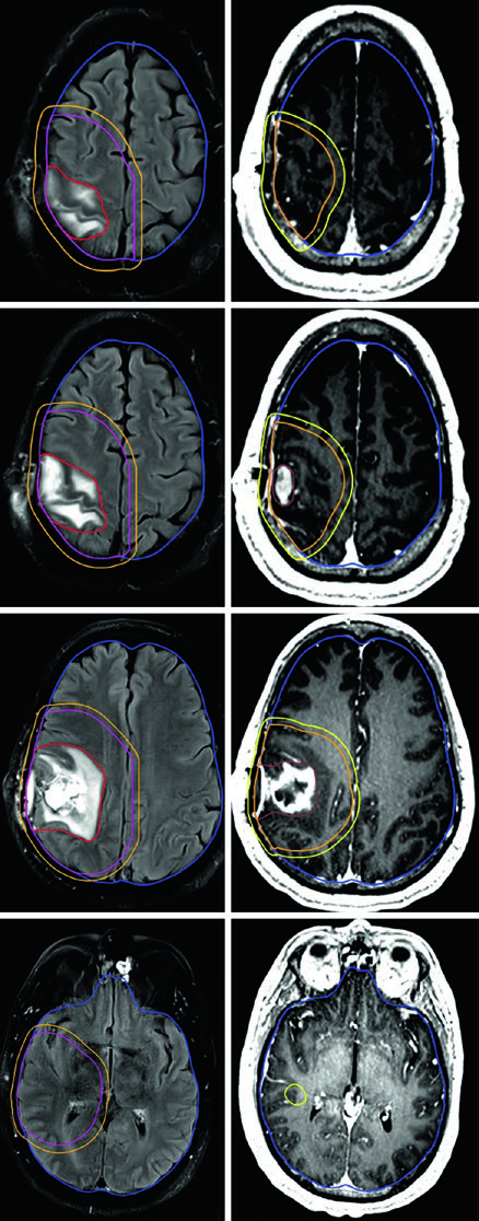 RM de planejamento FLAIR e T1 pós-contraste para glioblastoma parietal direito mostrando dois volumes sequenciais: PTV1 em laranja a 46 Gy e PTV2 em amarelo a 60 Gy