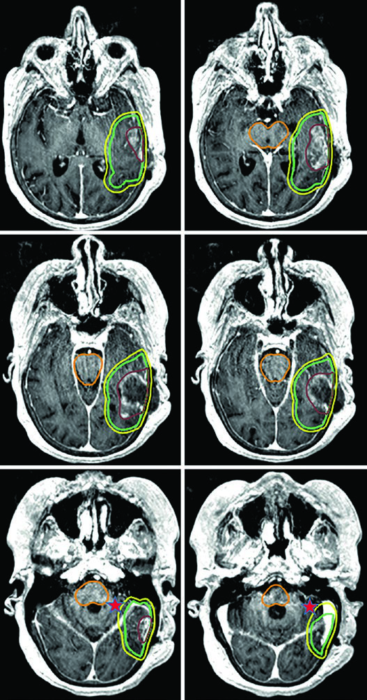 RM T1 pós-contraste para glioblastoma temporal posterior esquerdo em paciente idoso tratado com 40 Gy em 15 frações, GTV em marrom, CTV em verde restrito ao tentório e PTV em amarelo