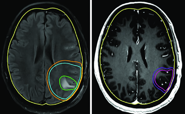 RM T1 pós-contraste de glioblastoma cerebelar direito tratado com 30 Gy em 5 frações mostrando GTV em vermelho, CTV em rosa com margem de 0,5 cm e PTV em laranja claro