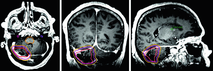 RM FLAIR e T1 pós-contraste de gliossarcoma temporal occipital esquerdo mostrando PTV1 em laranja a 46 Gy e PTV2 em roxo a 60 Gy com tronco encefálico contornado em azul