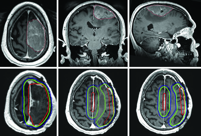 RM T1 pós-contraste mostrando meningioma maligno grau III frontoparietal esquerdo com extensão da doença pré-operatória em marrom e volumes pós-operatórios GTV em vermelho, CTV em verde com margem de 1 cm e PTV em azul