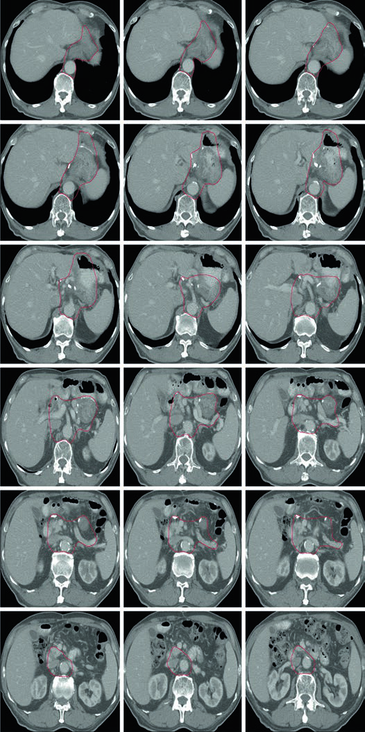 Série de cortes axiais mostrando o CTV após gastrectomia distal por adenocarcinoma do antro ou piloro, com cobertura da anastomose gastrojejunal, coto duodenal, ligamento hepatogástrico e hilo esplênico opcional.