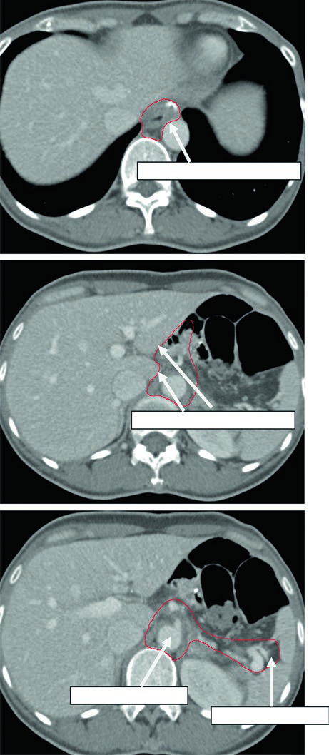 Tomografias axiais com setas destacando cobertura da anastomose esofagojejunal, ligamento hepatogástrico, artéria celíaca e hilo esplênico no planejamento adjuvante do câncer gástrico proximal.