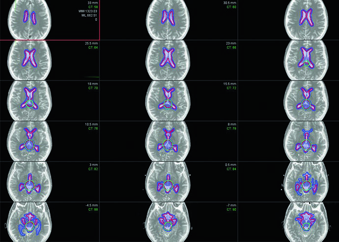 Imágenes axiales mostrando CTV ventricular total en rojo, PTV ventricular en azul y PTV de boost en verde en germinoma donde el boost se extiende más allá del contorno ventricular