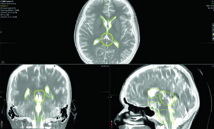 RM T2 mostrando volumen ventricular total delineado en verde lima y volumen de boost en amarillo en germinoma bifocal con ventriculostomía