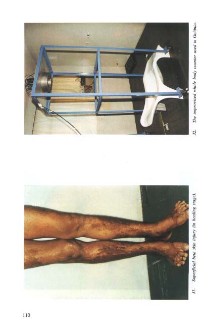 Contador de corpo inteiro improvisado em Goiânia para avaliação de contaminação interna por césio-137, com detector NaI montado em estrutura metálica e cadeira de lazer como suporte para o paciente