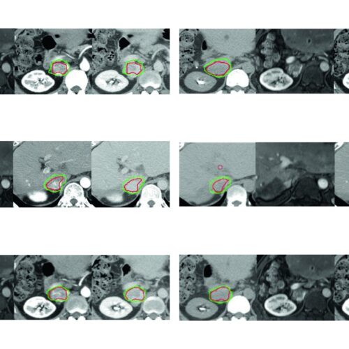Carcinoma Hepatocelular: Delineamento na RT