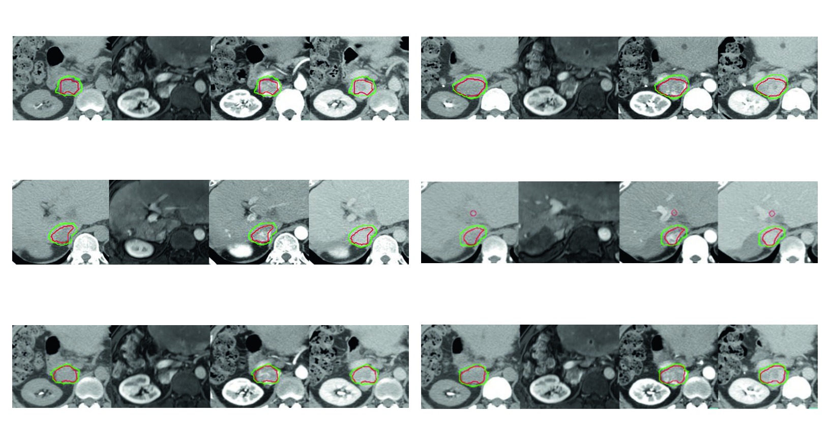 Carcinoma Hepatocelular: Delineamento na RT