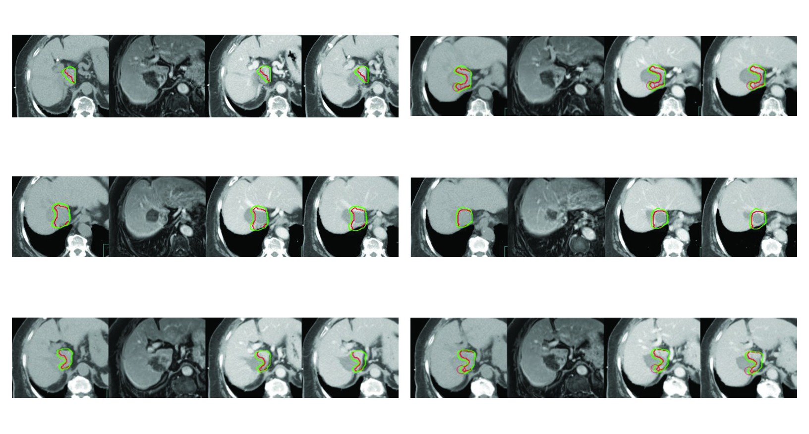 Figura 17.2 do capitulo de carcinoma hepatocelular com recorrencia e trombose parcial da veia cava inferior, GTV em vermelho e CTV em verde em simulacao multiphasica