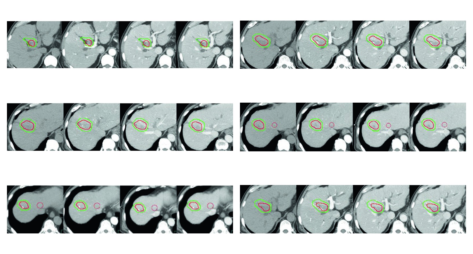 Figura 17.3 do capitulo de carcinoma hepatocelular com recorrencia apos cirurgia e radiofrequencia, incluindo margem de 5 mm no parenquima hepatico e 3 mm no espaco intravascular