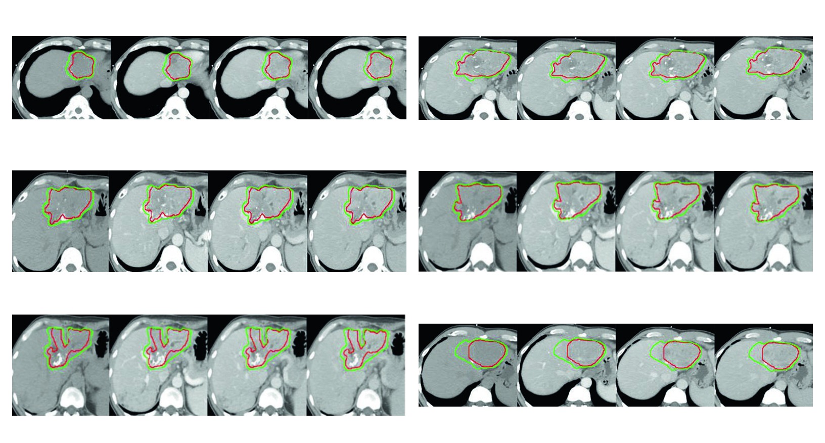 Figura 17.4 do capitulo de carcinoma hepatocelular com tromboses na veia porta e na veia hepatica media em HCC refratario ao sorafenibe