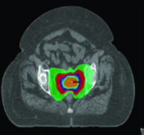 Plano de próton-terapia IMPT axial para câncer cervical com envolvimento de linfonodos pélvicos