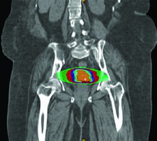 Plano IMPT coronal para câncer cervical mostrando cobertura pélvica e nodal