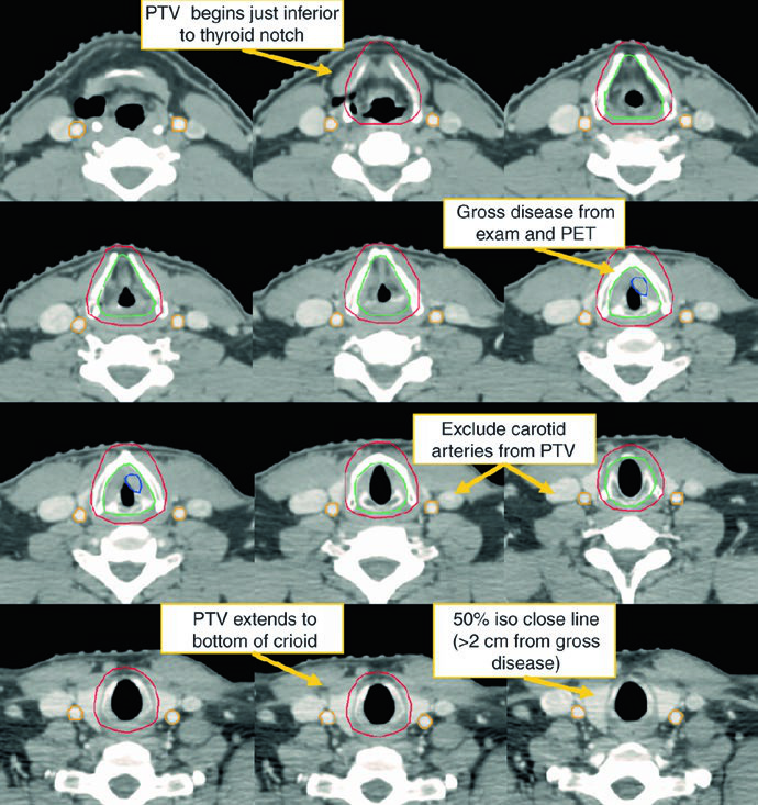 Representative axial planning slices for T1aN0 left vocal cord carcinoma with GTV, CTV, PTV, and carotid sparing.