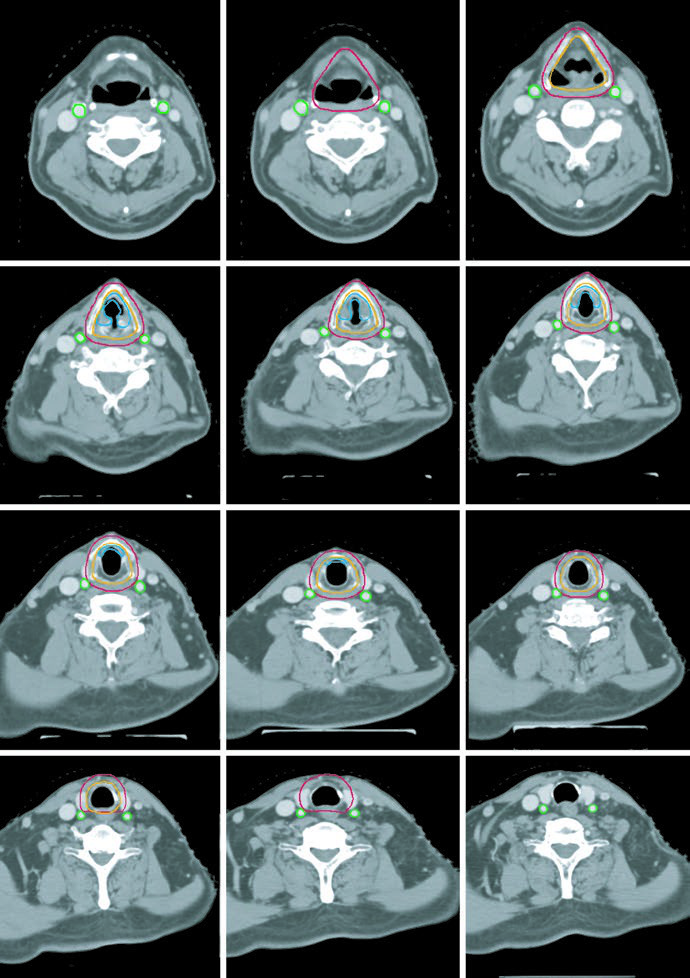 Axial planning image for T1bN0M0 carcinoma involving both vocal cords with GTV, CTV, and PTV.