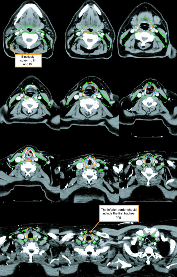 Representative T2N0M0 supraglottic case with GTV, CTV54, CTV60, and CTV70.