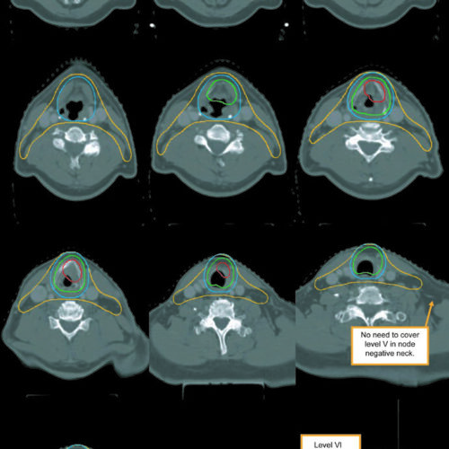 Câncer de Laringe: Delineamento e Campos