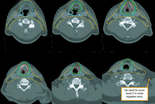 Planning slices for T3N0M0 left vocal cord carcinoma with anterior commissure spread, subglottic extension, and inner thyroid cartilage invasion, showing GTV, CTV54, CTV60, and CTV70.
