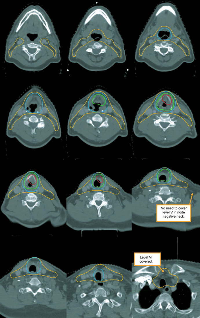 Larynx Cancer: Target Delineation and Fields