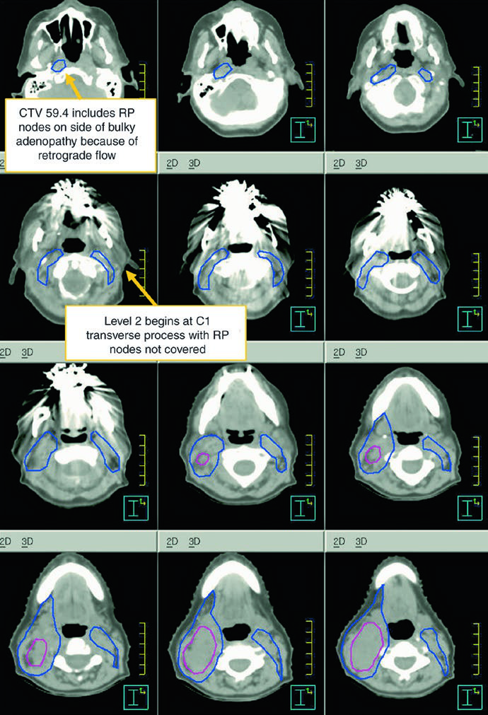 T2N2cM0 epiglottic carcinoma with primary GTV, nodal GTV, CTV60, and CTV54.