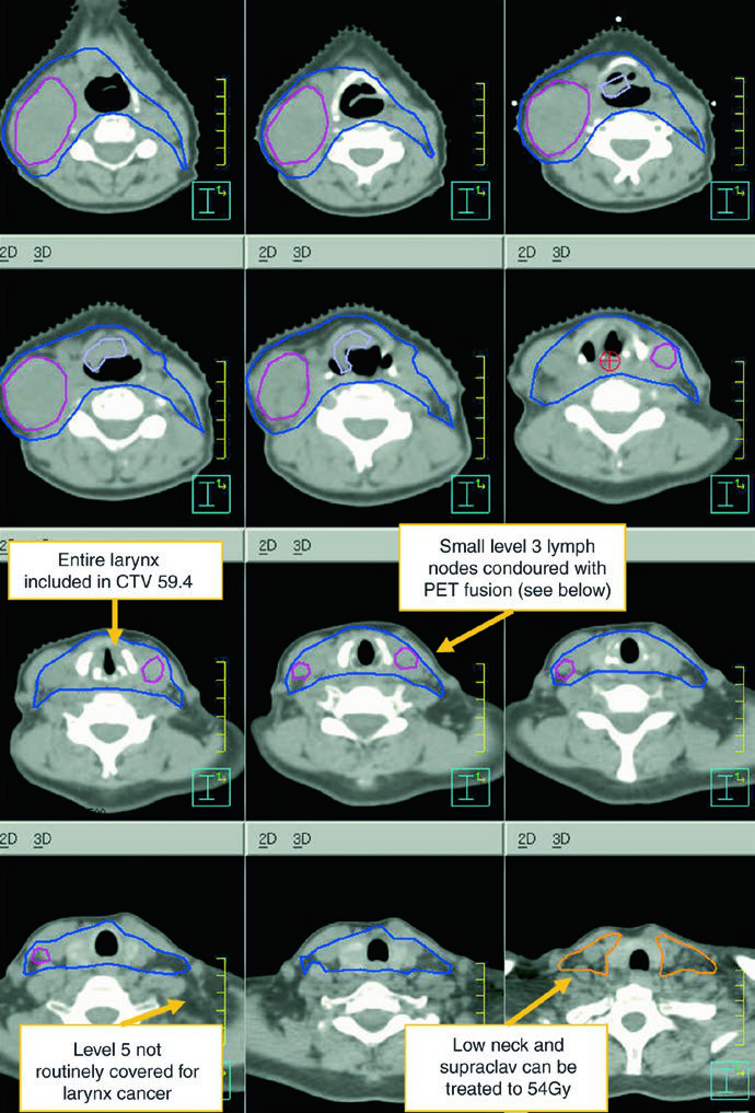 Continuation of the epiglottic example showing additional bilateral cervical coverage.