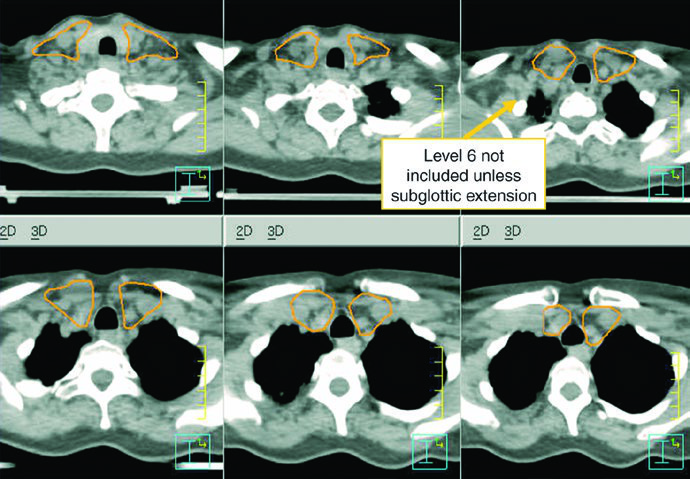 Inferior neck slices from the same epiglottic case showing elective and gross nodal coverage.