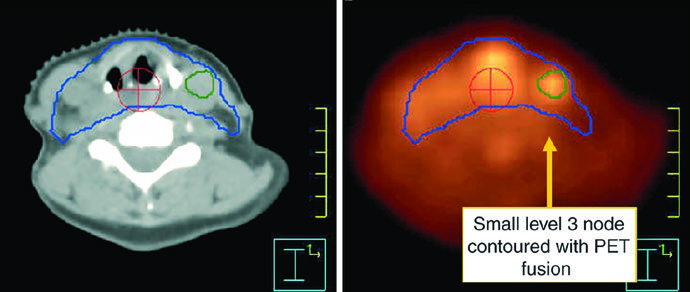Lower-neck detail from the epiglottic nodal case, useful for discussing caudal coverage and upper tracheal inclusion.