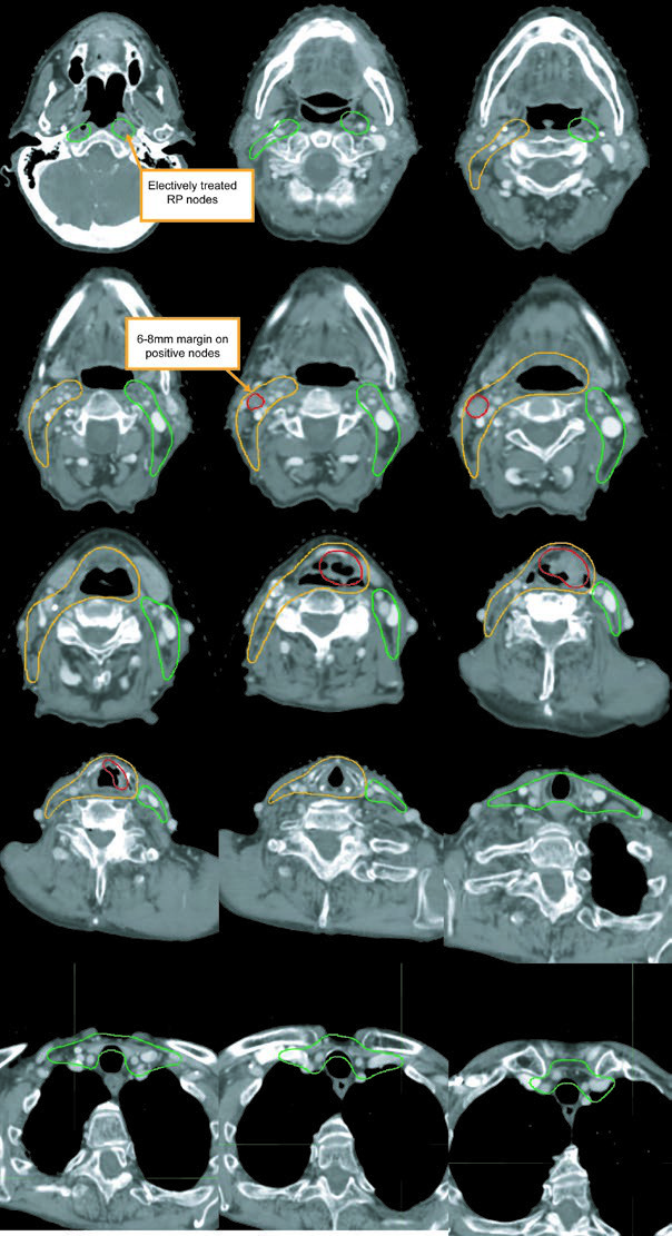 T3N1M0 supraglottic carcinoma with subglottic extension showing GTV, CTV60, and CTV54.