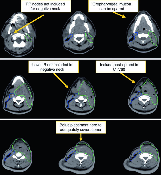 Post-laryngectomy pT4N0M0 case showing postoperative CTV54 and CTV60.