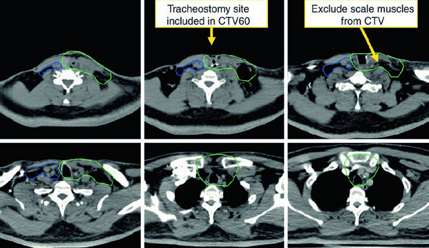 Additional postoperative slices emphasizing operative bed and stoma coverage.