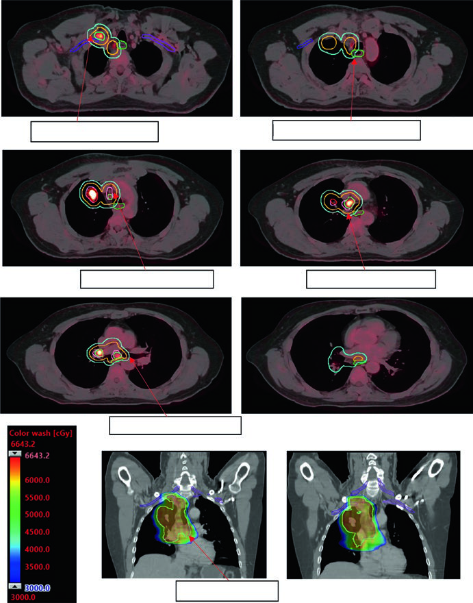 Expansão de 0,7 cm de iGTV para iCTV e de 0,5 cm de iCTV para PTV em NSCLC localmente avançado
