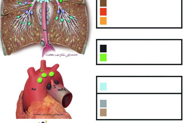 Mapa anatômico das estações linfonodais torácicas e mediastinais no câncer de pulmão