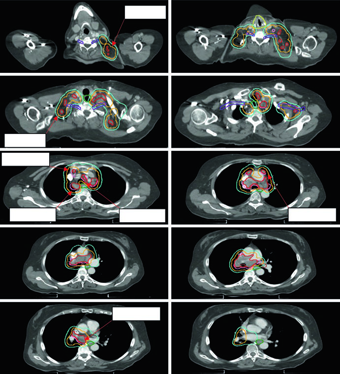 Adenocarcinoma pulmonar localmente avançado com envolvimento supraclavicular bilateral e contornos de GTV, iGTV, iCTV e PTV