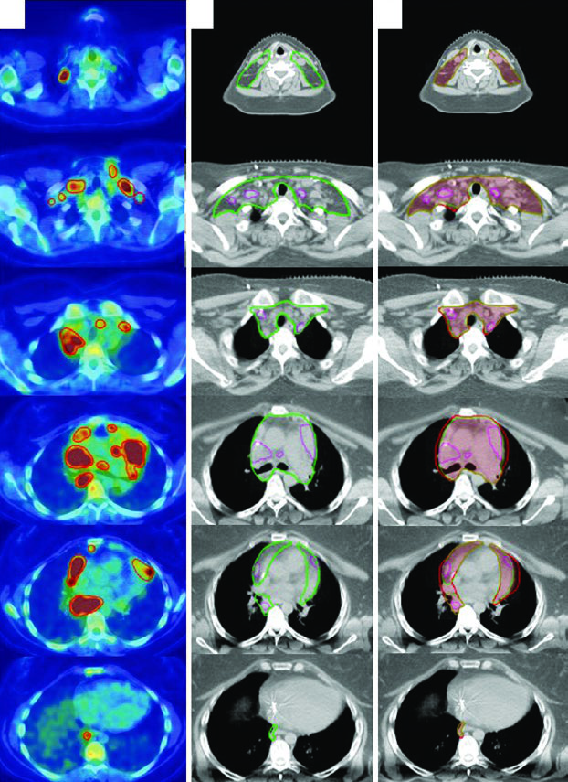 Axial image set for stage IIB bulky nodular sclerosing Hodgkin lymphoma involving cervical, supraclavicular, mediastinal, and bilateral hilar regions, showing pre-chemotherapy GTV, post-chemotherapy GTV, CTV, and ITV after 4D CT.