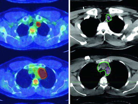 Axial pre-chemotherapy PET/CT and simulation CT for stage IIA nodular sclerosing Hodgkin lymphoma with left supraclavicular and mediastinal involvement, showing pre-chemotherapy GTV, post-chemotherapy residual disease, and ISRT CTV.