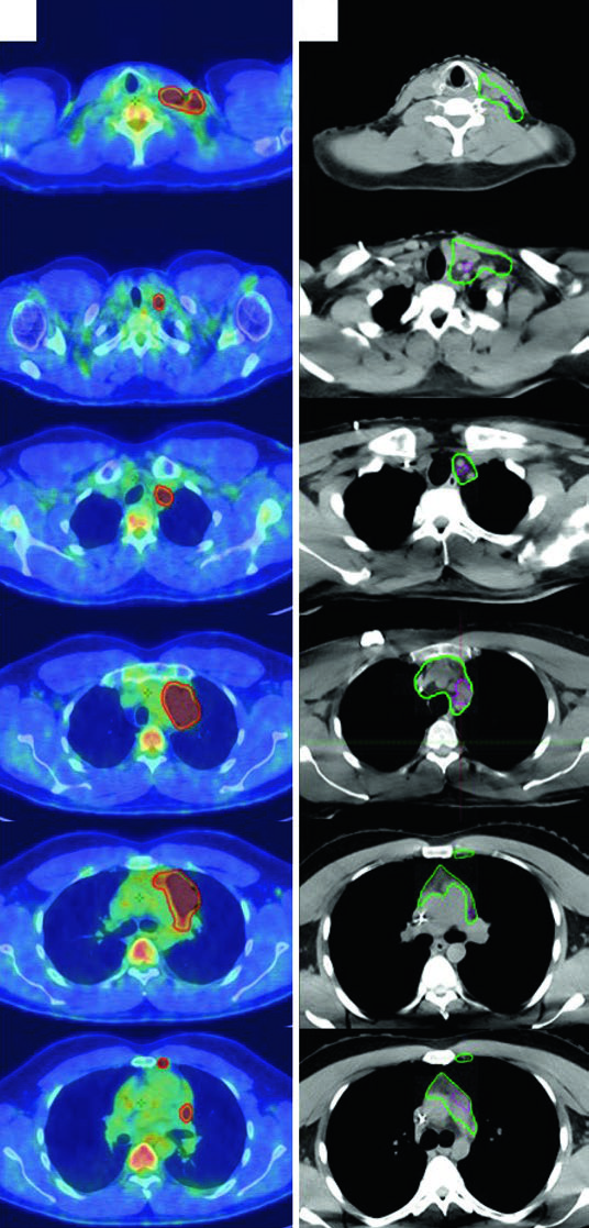 Lymphoma Target Delineation and Field Setup