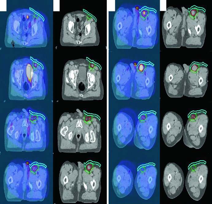 PET/CT fused with simulation CT for stage IA follicular lymphoma of the left inguinal and femoral region, showing gross disease, ISRT CTV, institution-specific PTV margin, and superficial bolus use.