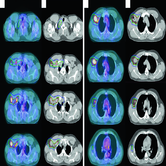 Diagnostic PET/CT registered to simulation CT for stage IIA nodular lymphocyte-predominant Hodgkin lymphoma of the right supraclavicular, subpectoral, and axillary regions, with gross disease, ISRT CTV, and PTV margin.