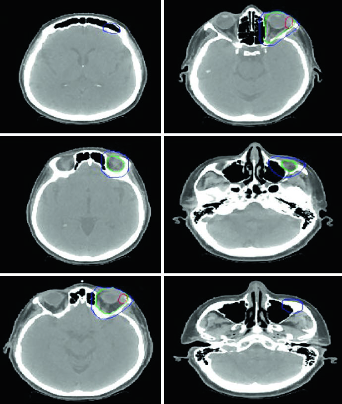 Simulation CT for stage IAE MALT lymphoma of the left lacrimal gland, showing gross disease, whole-orbit ISRT CTV, and institution-specific PTV margin.