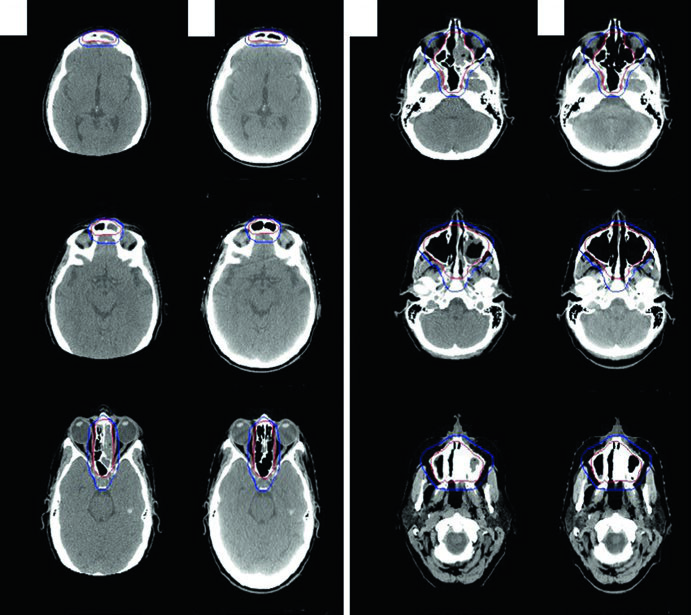 Preoperative and simulation CT slices for stage IAE diffuse large B-cell lymphoma of the left ethmoid and sphenoid sinus with extension across the nasal septum, showing involved-sinus ISRT CTV and PTV margin after near-total resection and R-CHOP.