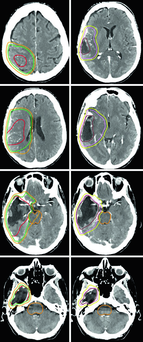 Malignant CNS Tumors: Target Delineation
