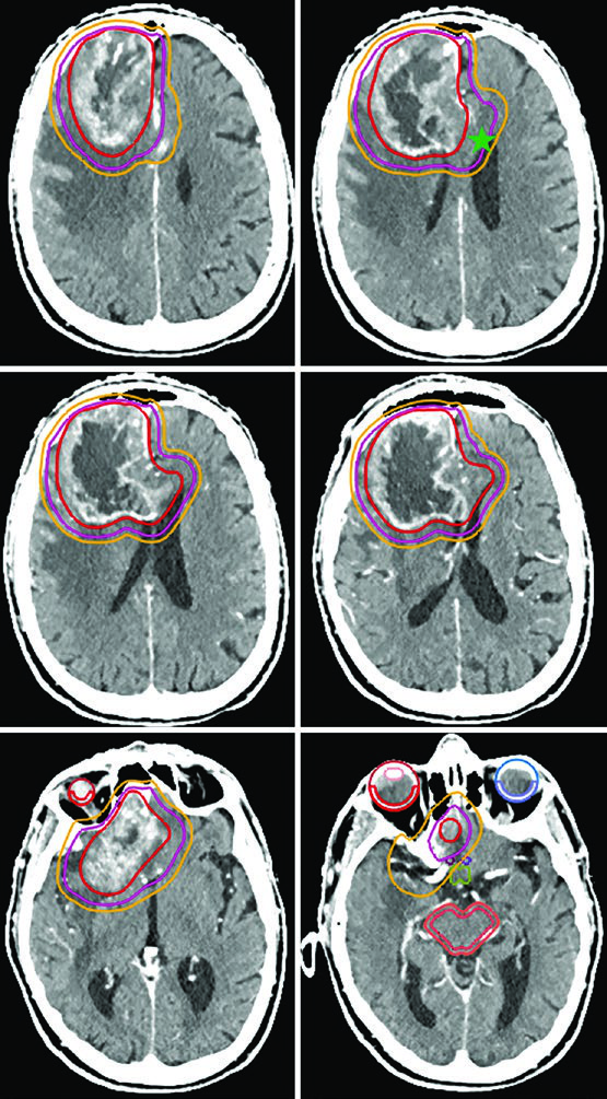 Contrast-enhanced planning CT for right frontal glioblastoma in an elderly poor-risk patient, with a post-contrast T1-defined GTV, a 0.5 cm CTV, a 0.3 cm PTV, and visible organs at risk.